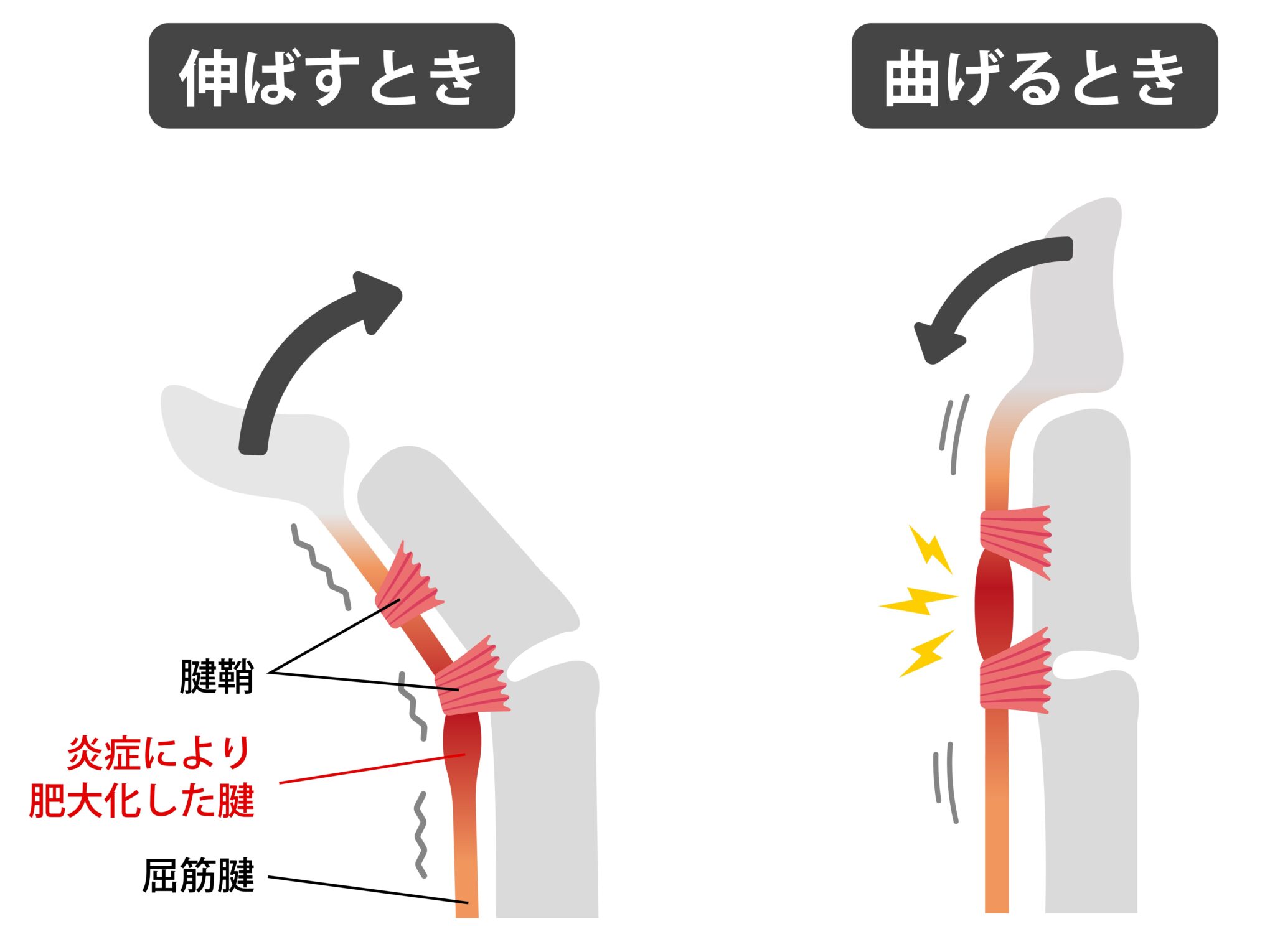 手の腱鞘炎｜ばね指・ドゥケルバン病の見分け方と負担を減らす使い方｜かなえるリハビリ
